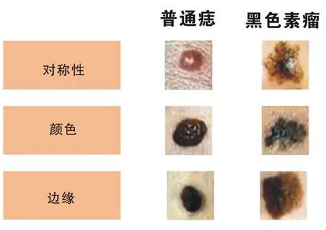 臉部黑痣|是痣還是瘤？黑色素瘤的類型、症狀與治療